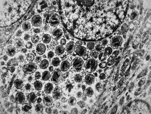 F,69y. | cystadenoma (Warthin tumor) … caruncula - (modified mitochondria in an autolysed sample)